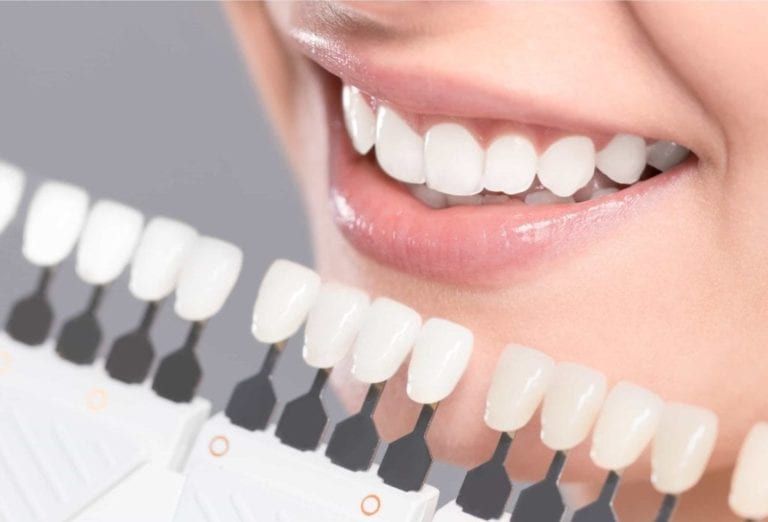 smiling woman teeth with veneers