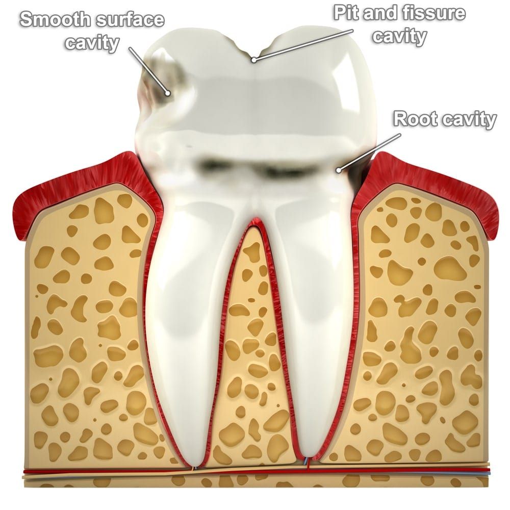 types of dental cavities