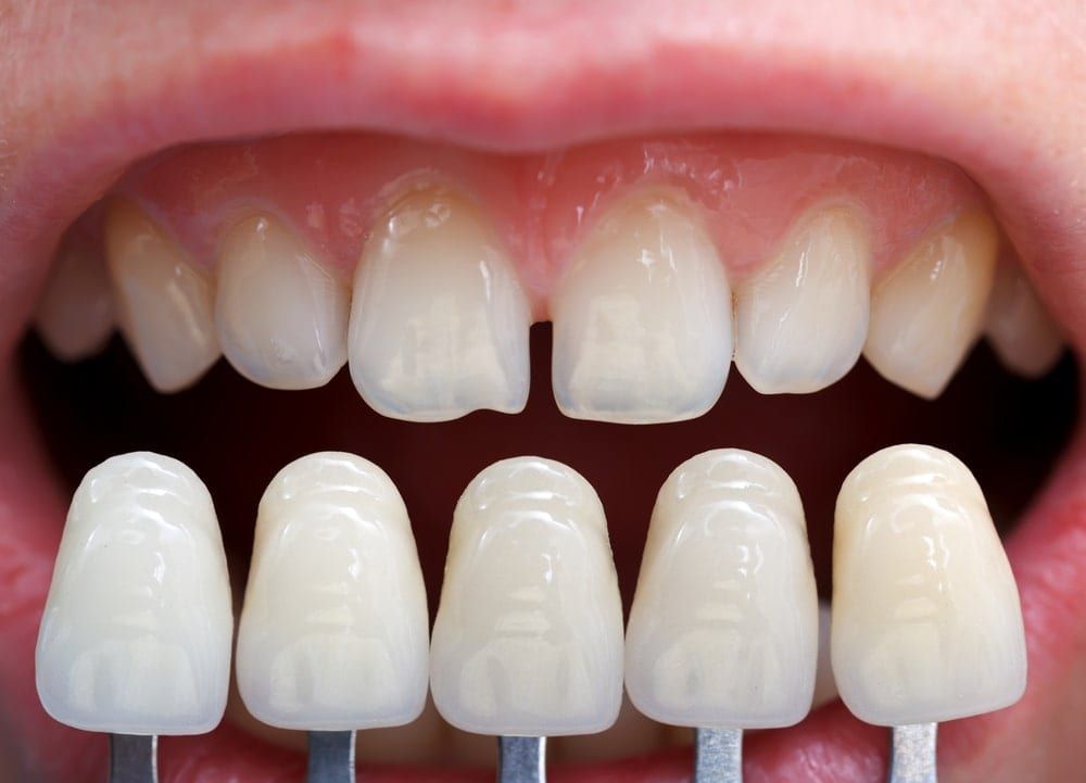 veneers shown over natural teeth
