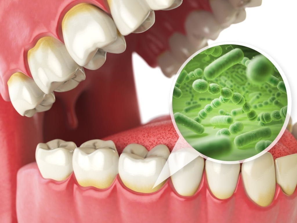 bacteria buildup along the gums