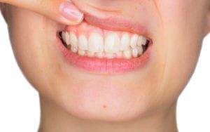 Woman pulling back teeth to look for periodontal disease