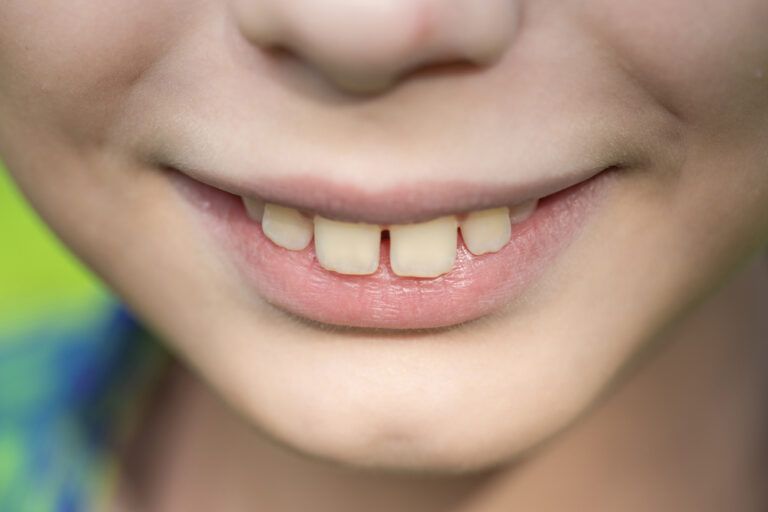 9 Common Orthodontic Problems To Look Out For in Kids